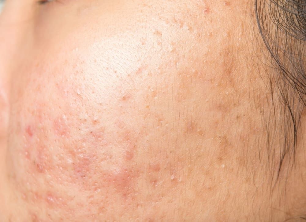 what-you-should-do-when-your-skin-is-purging-tretinoin-purge-acne